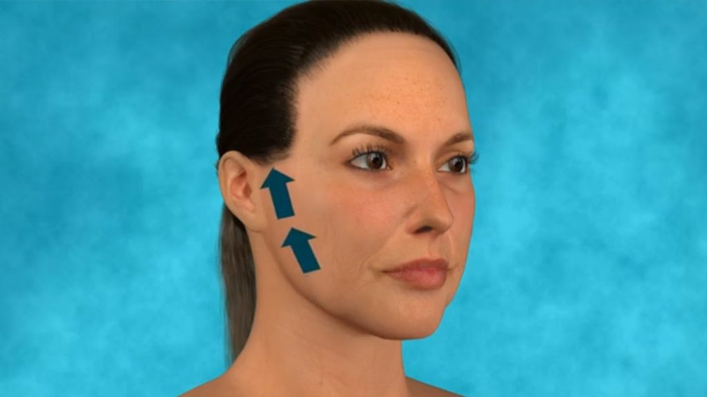What To Expect From A Mini Facelift