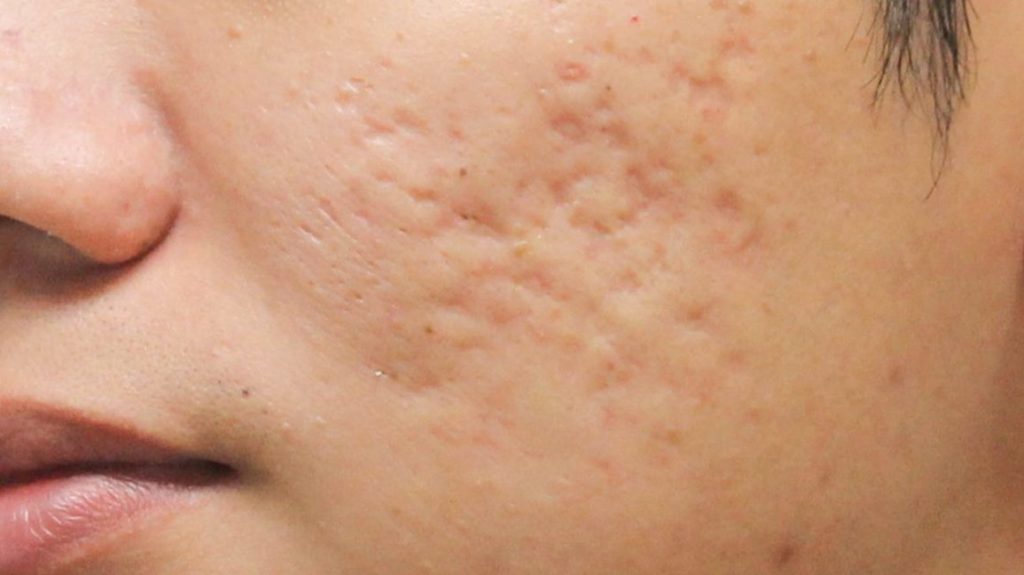 Acne Scar Treatment: How to Get Rid of Depressed Acne Scars for Good