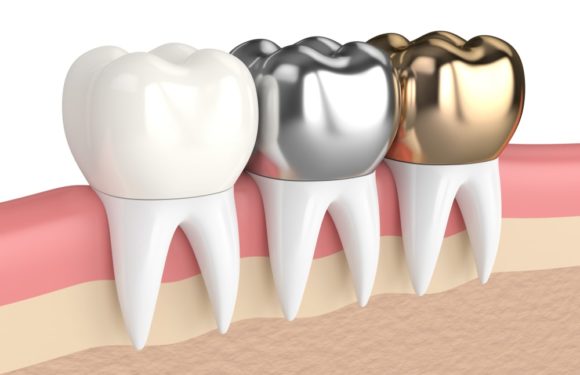Dental Crowns: What are the Different Types?