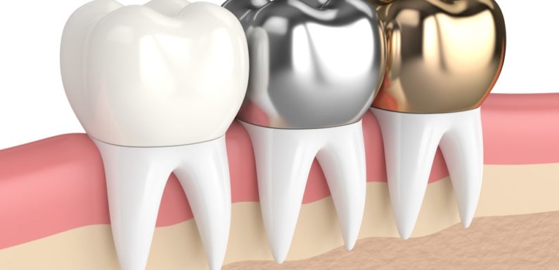 Dental Crowns: What are the Different Types?