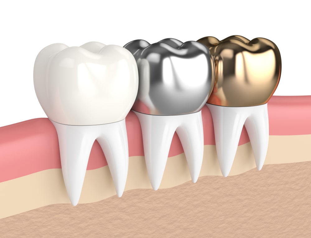 Dental Crowns: What are the Different Types?