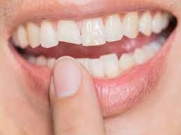 Teeth Whitening Singapore: Can you go from Yellow to White Teeth?