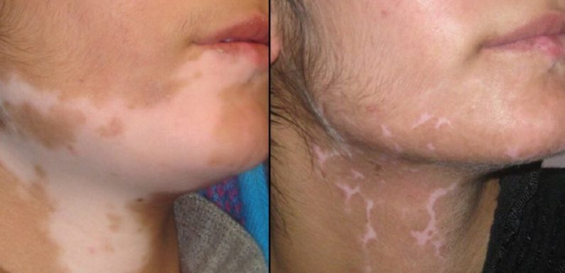 Do you know any vitiligo disease treatment?