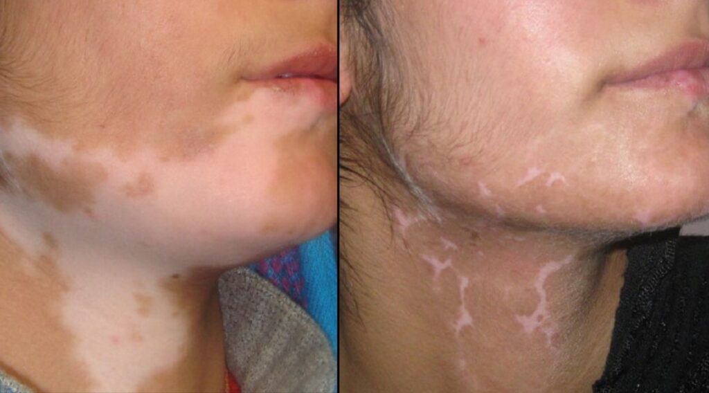 Do you know any vitiligo disease treatment?