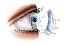 What Exactly Are Corneal Dystrophies?
