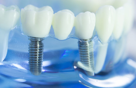 Should Cavities in Baby Teeth be Filled in Cumming, GA?