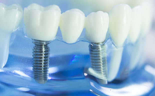 Should Cavities in Baby Teeth be Filled in Cumming, GA?