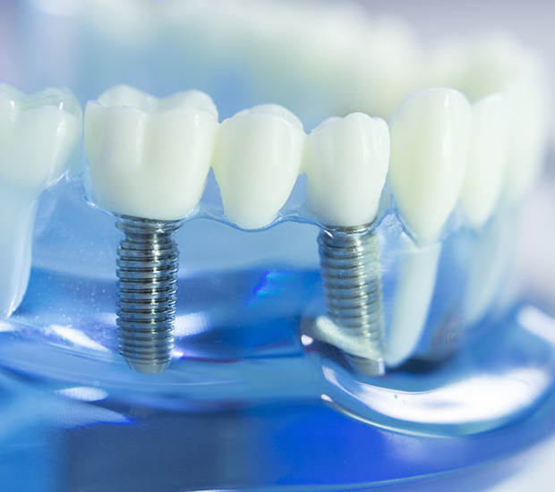 Should Cavities in Baby Teeth be Filled in Cumming, GA?