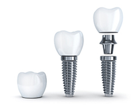 Zirconia vs. Titanium: Which Is the Better Material for Implants?