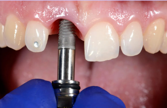 Understanding Dental Implant Surgery: What to Expect