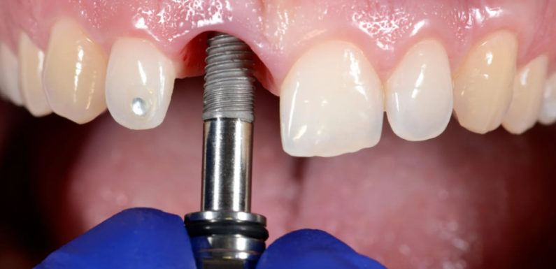 Understanding Dental Implant Surgery: What to Expect