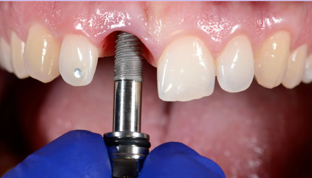 Understanding Dental Implant Surgery: What to Expect