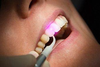Everything You Need to Know About Laser Teeth Whitening