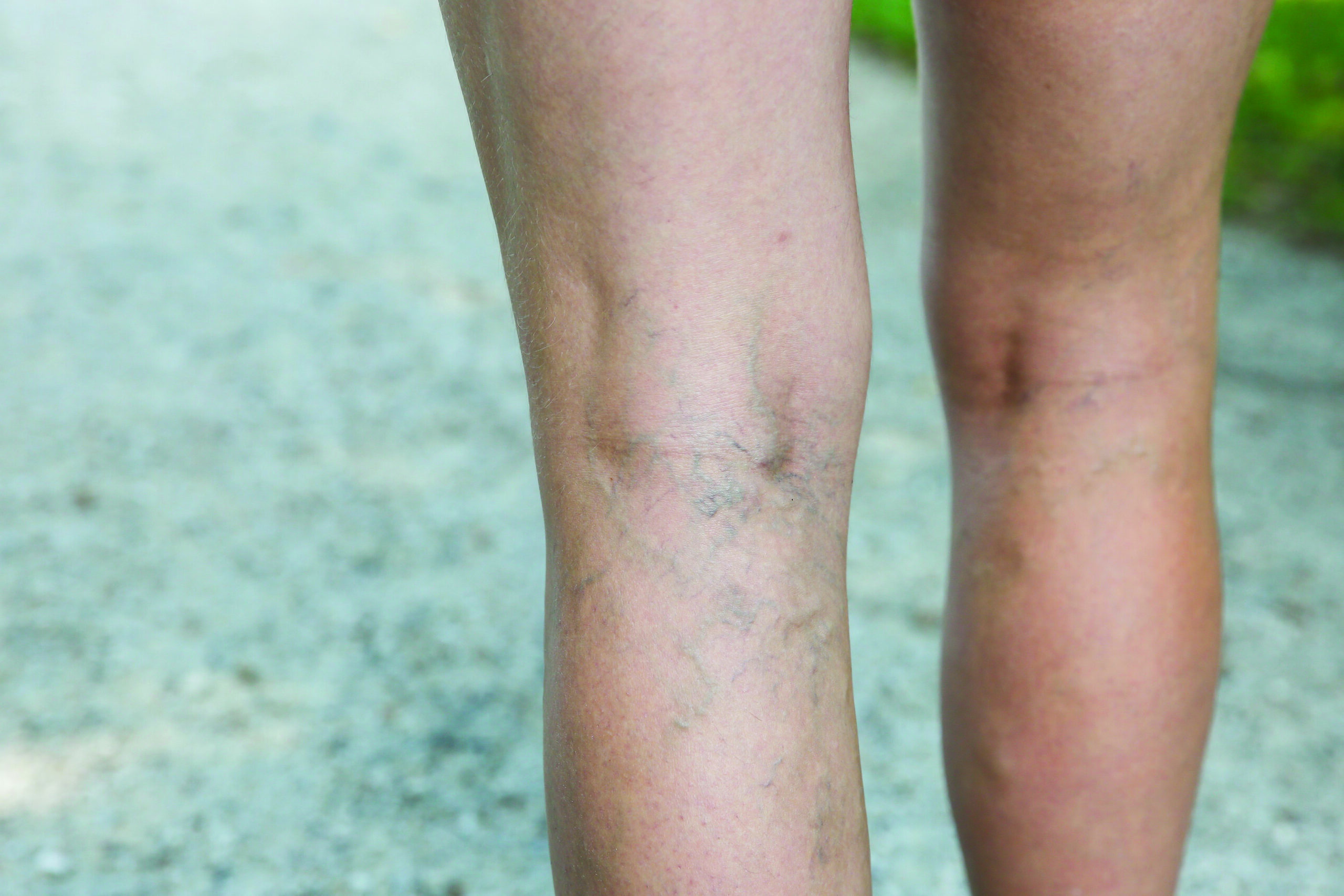 Vascular Health Chronicles: All About Spider Veins