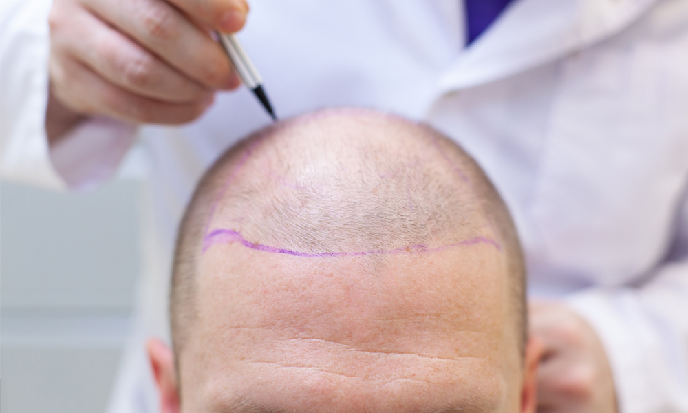 Micropigmentation services are a popular choice for hair restoration Micropigmentation services