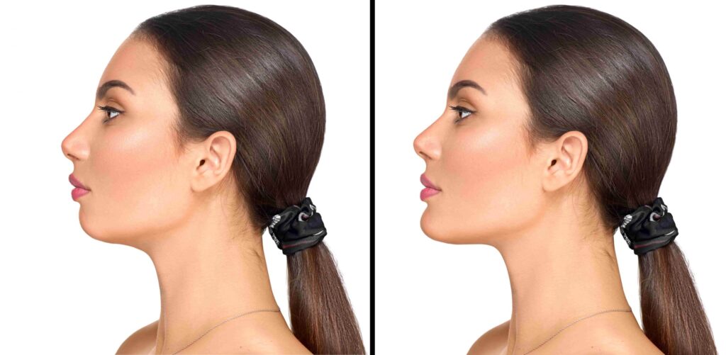 Defining Elegance: A Comprehensive Guide to Chin Surgery Prices with a Focus on Dubai