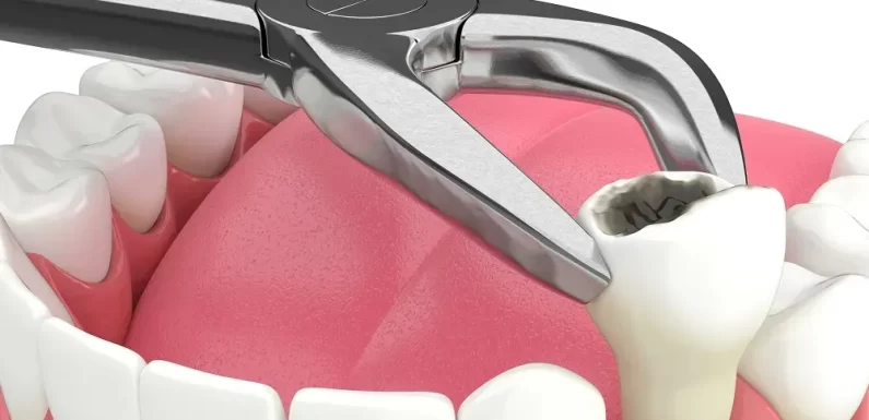 Addressing Dry Socket: Best Practices And Emerging Treatments