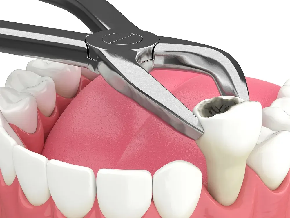 Addressing Dry Socket: Best Practices And Emerging Treatments