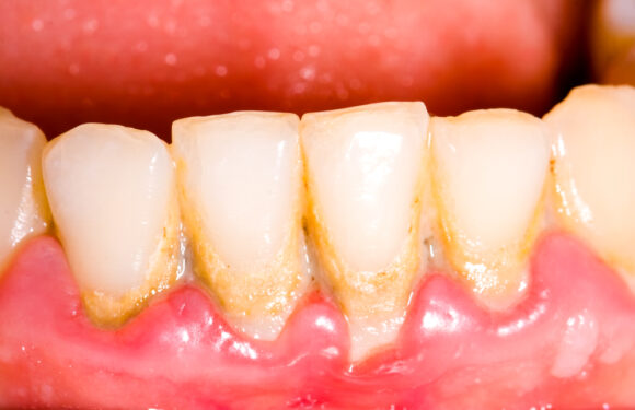 Holistic Solutions For Gum Disease And Tooth Decay