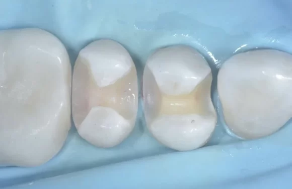 Embracing Minimally Invasive Air Abrasion For Enamel Preservation