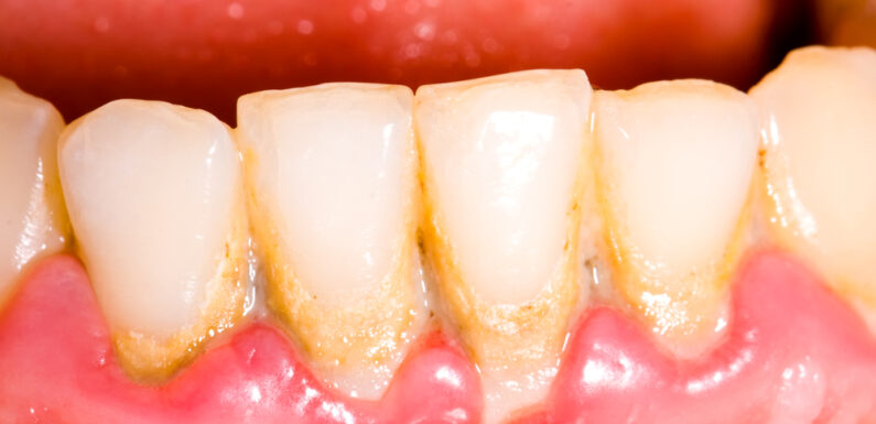 Holistic Solutions For Gum Disease And Tooth Decay