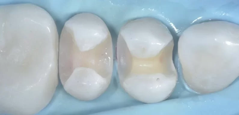 Embracing Minimally Invasive Air Abrasion For Enamel Preservation