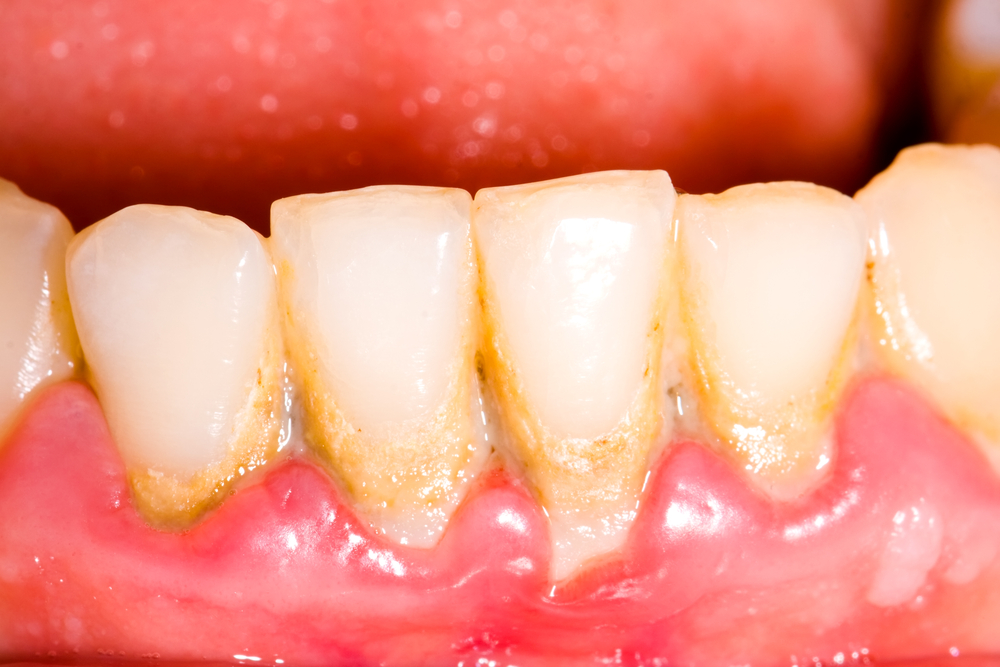 Holistic Solutions For Gum Disease And Tooth Decay