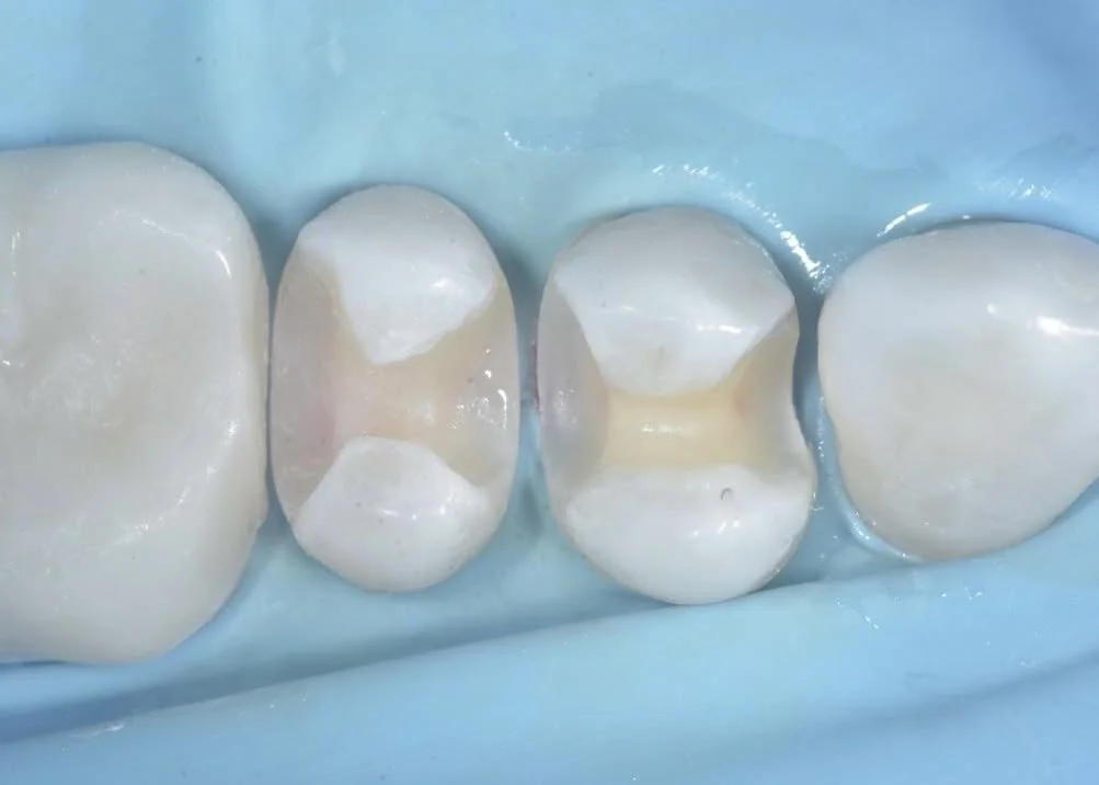 Embracing Minimally Invasive Air Abrasion For Enamel Preservation