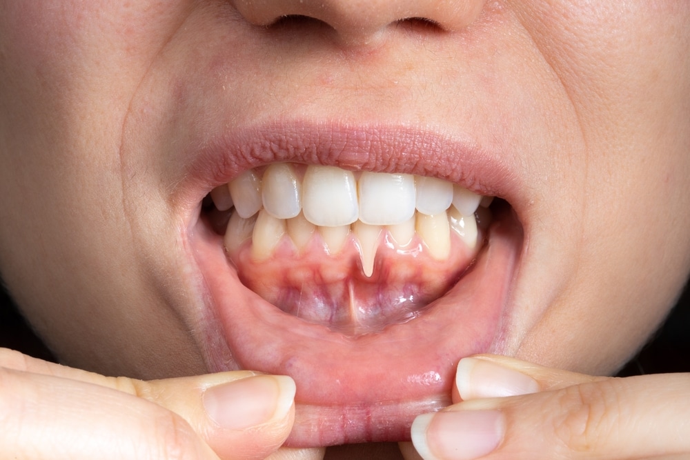 4 Common Preventive Services That Protect Against Gum Disease