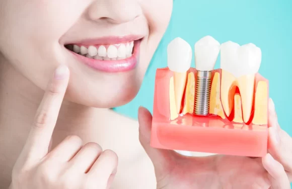 Dental Implants: The Ultimate Guide to Tooth Replacement