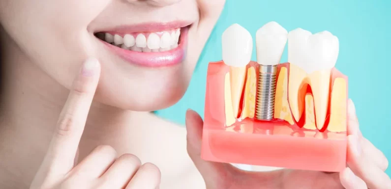 Dental Implants: The Ultimate Guide to Tooth Replacement