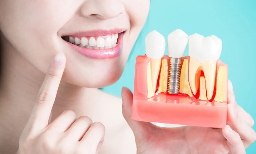 Dental Implants: The Ultimate Guide to Tooth Replacement Dental Implants
