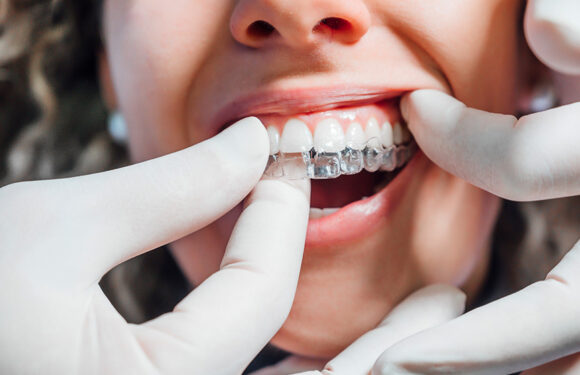 5 Indicators Of A Successful Clear Aligner Treatment Journey