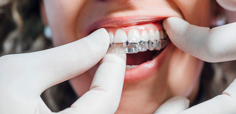 5 Indicators Of A Successful Clear Aligner Treatment Journey