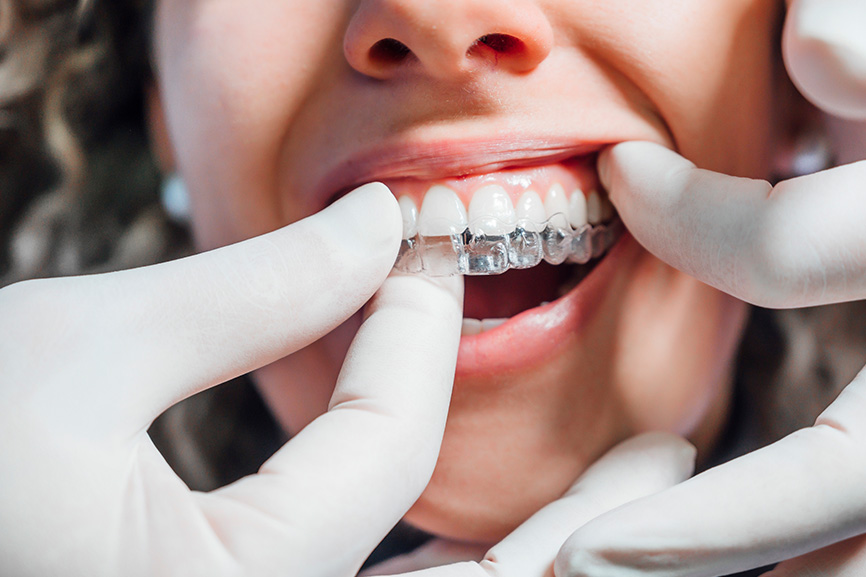 5 Indicators Of A Successful Clear Aligner Treatment Journey