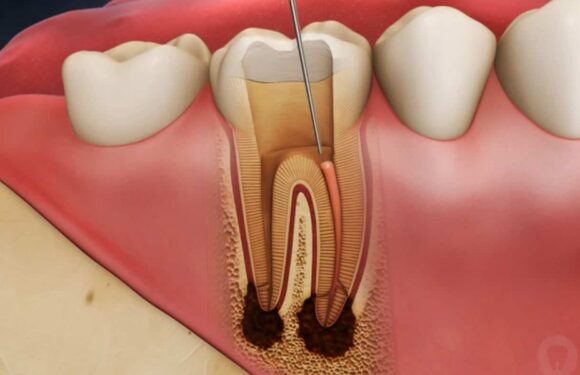 How an Endodontist in Singapore Uses 3D Imaging for Comprehensive Treatment