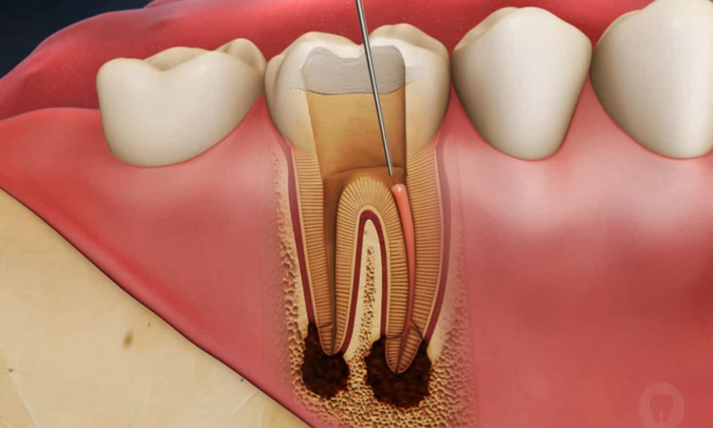 How an Endodontist in Singapore Uses 3D Imaging for Comprehensive Treatment