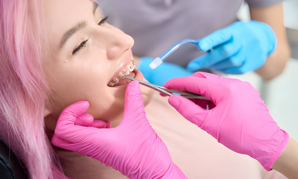 Understanding Your Fixed Metal Bracket Braces Options