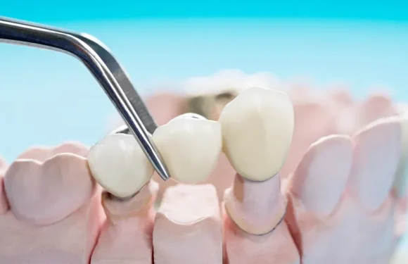 5 Benefits Of Choosing Clear Aligners For Smile Correction