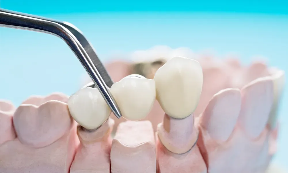 5 Benefits Of Choosing Clear Aligners For Smile Correction