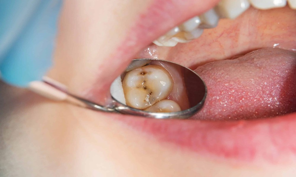 Why Fluoride Treatments Protect Against Generational Cavity Risks