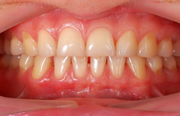 Why Gum Health Is The Make Or Break Factor For Cosmetic Dentistry