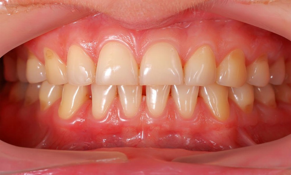 Why Gum Health Is The Make Or Break Factor For Cosmetic Dentistry