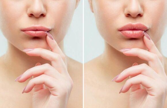 Juvederm Explained a Simple Way to Restore Natural Beauty