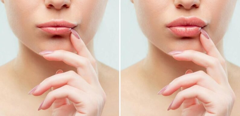 Juvederm Explained a Simple Way to Restore Natural Beauty