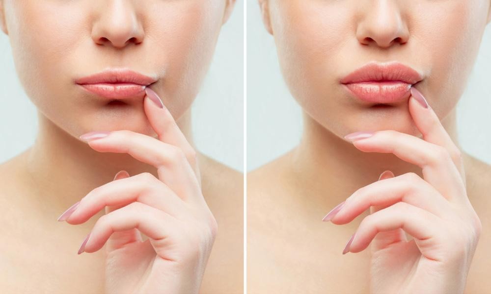 Juvederm Explained a Simple Way to Restore Natural Beauty