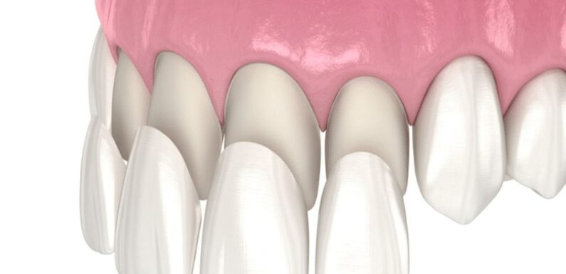 3 Common Veneer Margin Problems And How Dentists Prevent Them