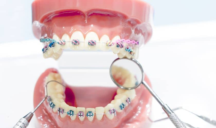 6 Factors That Influence How Long Teeth Whitening Results Really Last