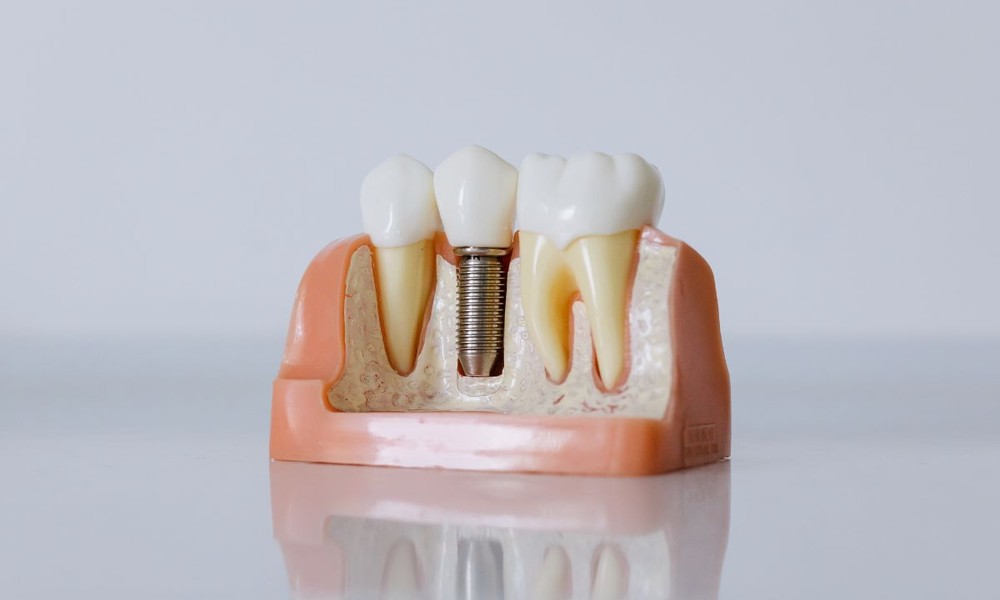 Why The Materials Used In Cosmetic Dental Implants Really Matter