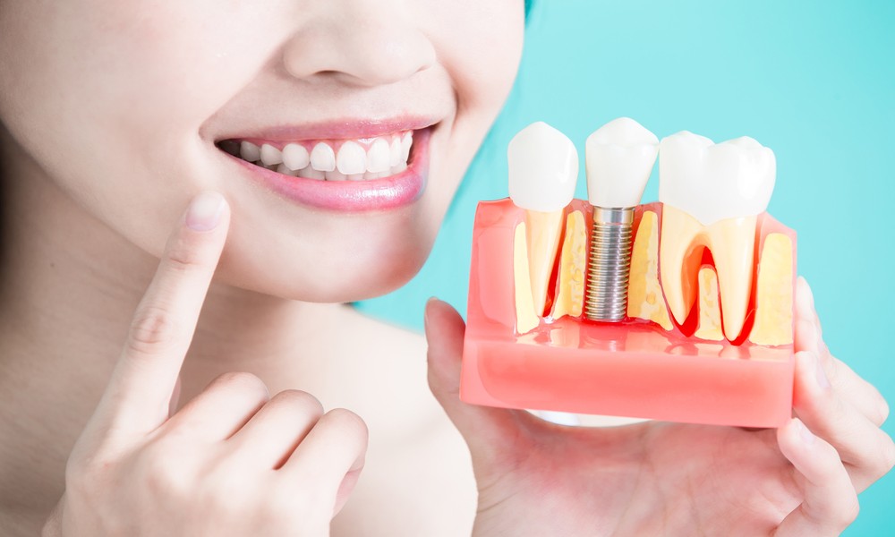 5 Things To Expect During The Dental Implant Process